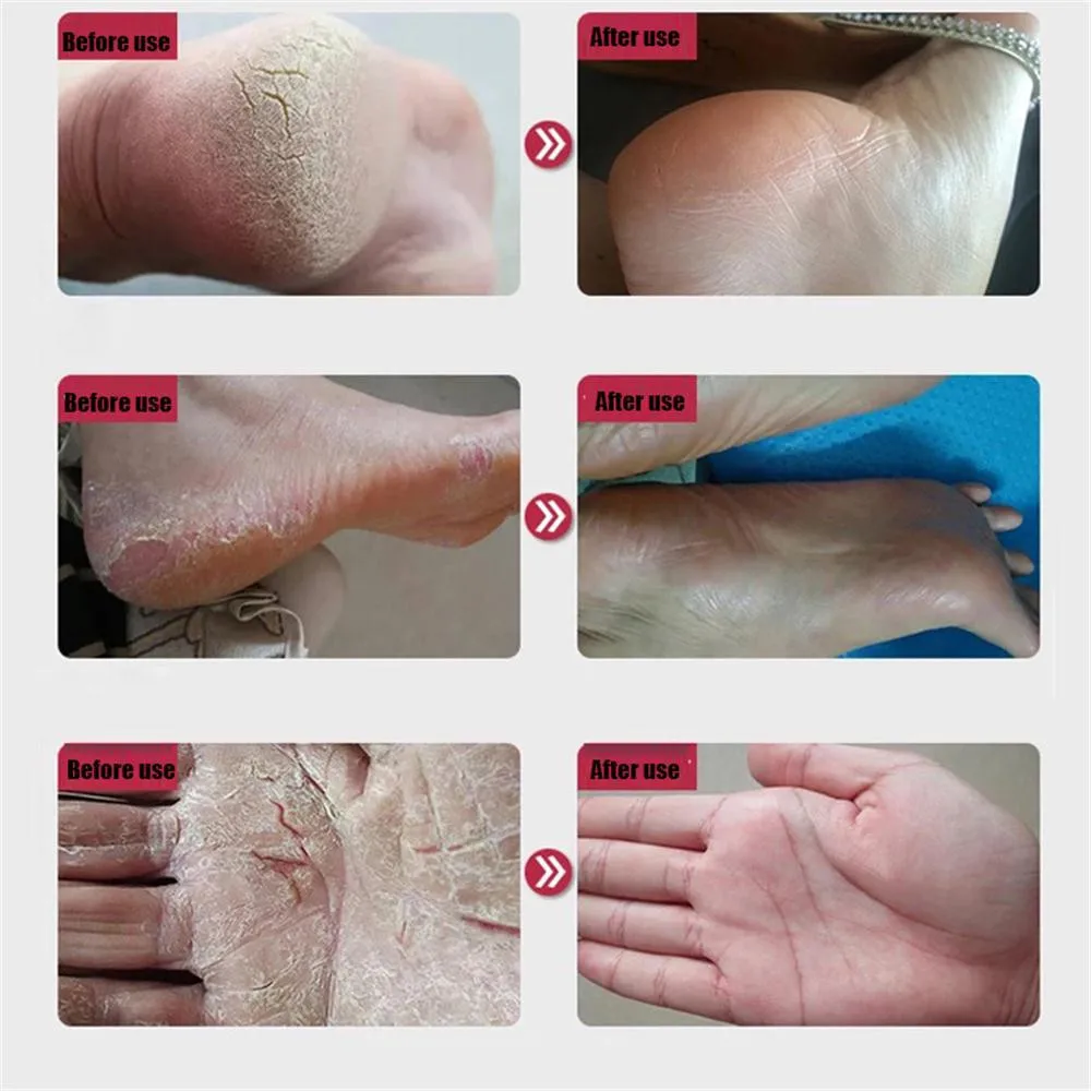 Highly Concentrated Moisturizing Agent Cracking Cream For Rough Dry And Cracked Heel Skin Anti-heel | Красота и здоровье