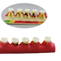 dental periodontal disease model typodont teeth model periodontics per 4010