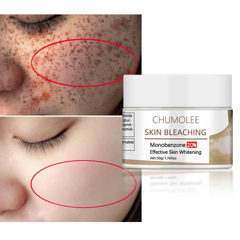 

*Chumolee Face Whitening Cream Skin Bleaching Monobenzone 20% Vitiligo Treament Fade Dark Spots Age Spot Melanin Brighten skin