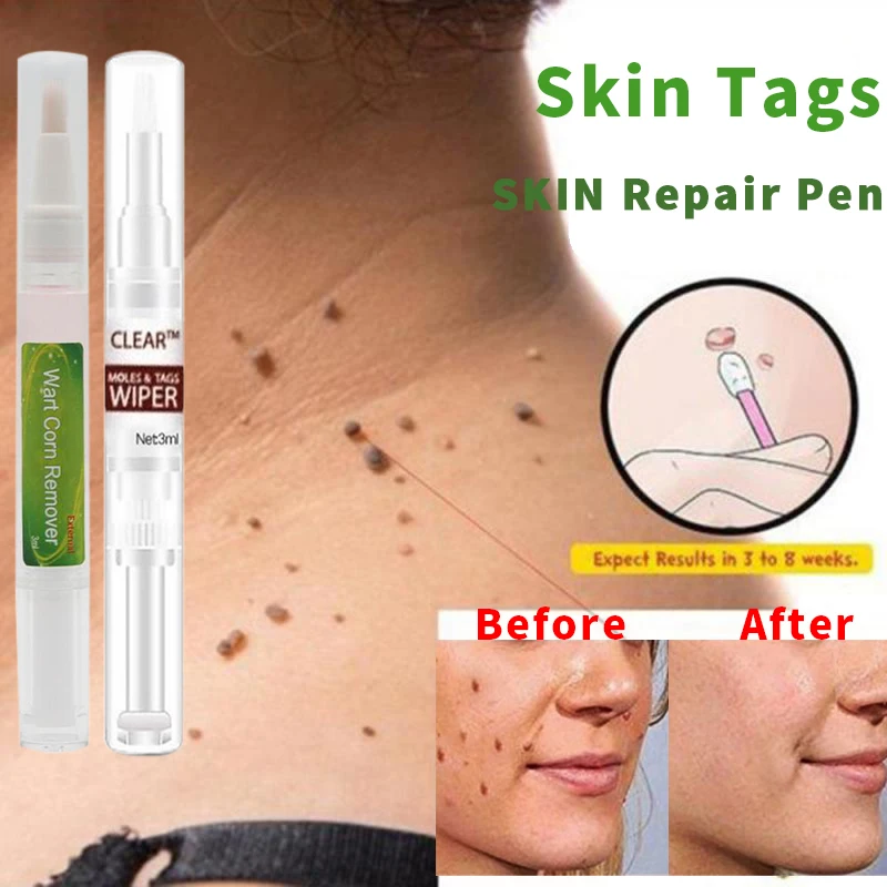 Новинка 3 мл лечение половых органов удаление папилломы бородавок жидкость с