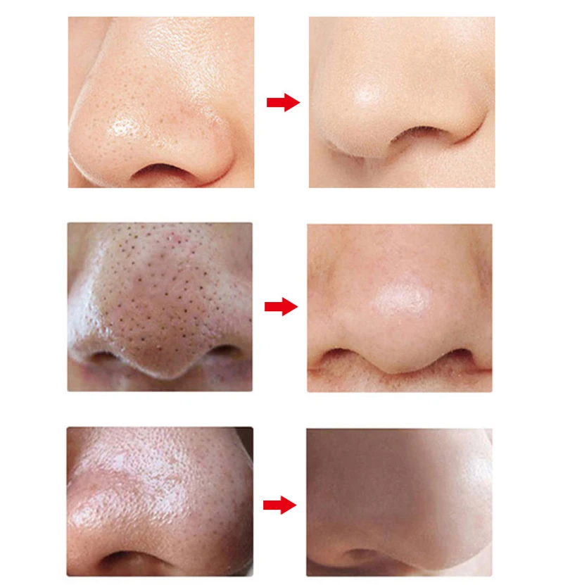 Blackhead Remover Vacuum Suction Face Deep Pore Cleaner Electric Acne Pimple Remover Tool Dark Spot Remover for Face Beauty Tool