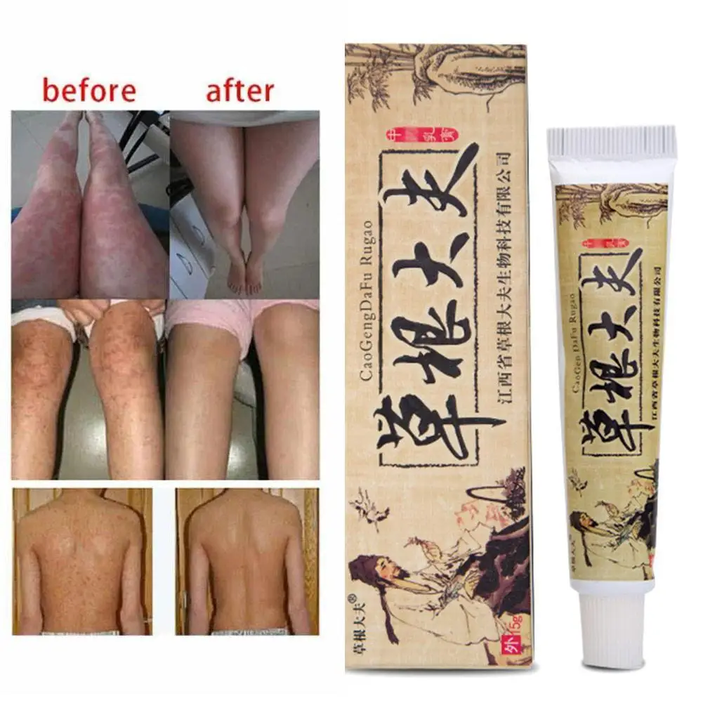 Китайский травяной крем от псориаза кожи зуд рельеф для тела Tinea versicolor Balanitis