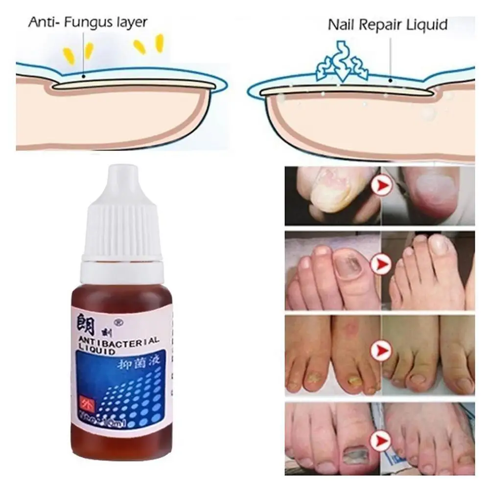 

Nail Fungal Treatment Essence Nail Foot Whitening Toe Gel Removal Anti Nail Onychomycosis Feet Paronychia Care Fungus Infec F7Y2