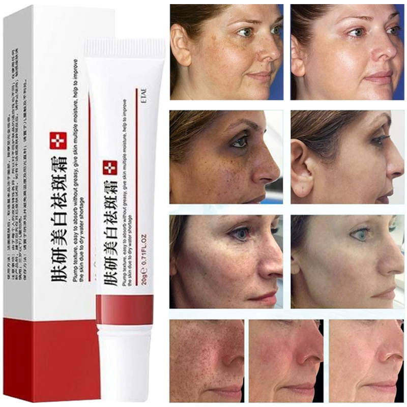 

Effective Freckle Cream Remove Dark Spots Witening Cream Fade Acne Melanin Pigmentation Melasma Anti-Aging Skin Care Lightenin