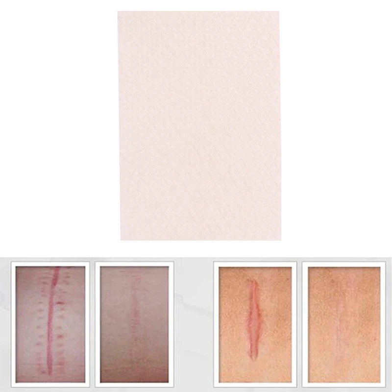Treatment Silicone Gel Scar Sheet Removal Patch Reusable Acne Gel Scar Therapy Sheet Skin Repair 1pc Visible Scar
