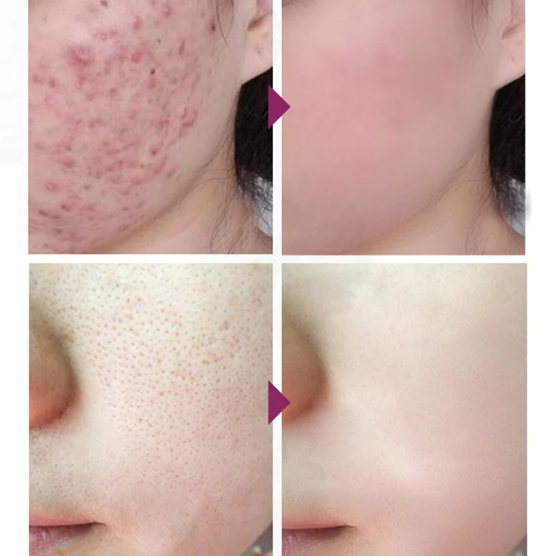 

Anti Acne Cream Spots Scar Treatment Cream Shrink Pores Moisturizing Skin Care CIN6 899