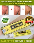 Крем для тела, мазь для лечения псориаза, экземы, дерматита, TSLM1