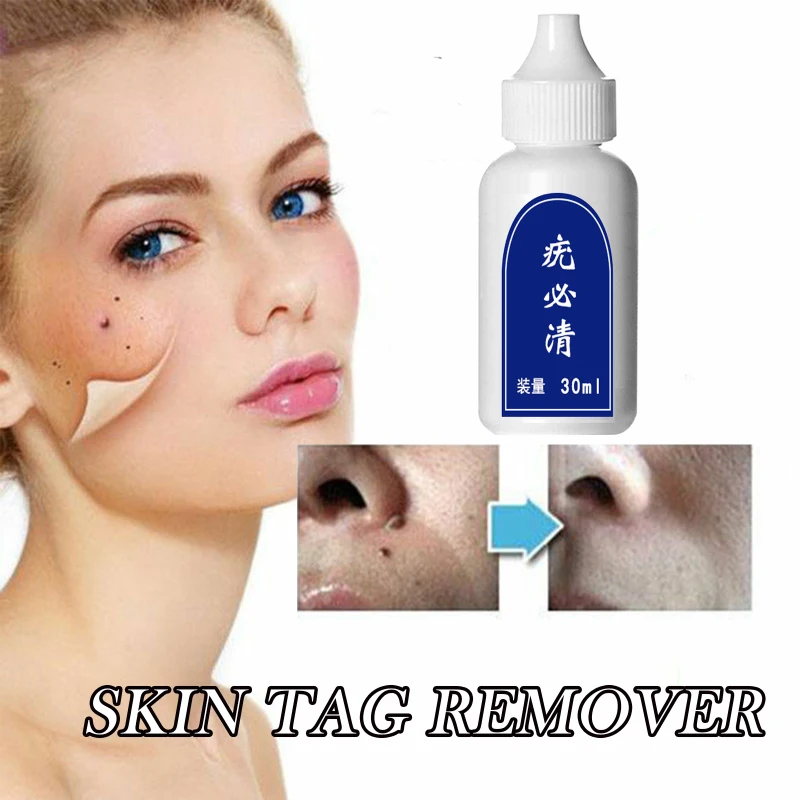 Бирка для удаления бородавок на коже средство лечения гениталий родинок и