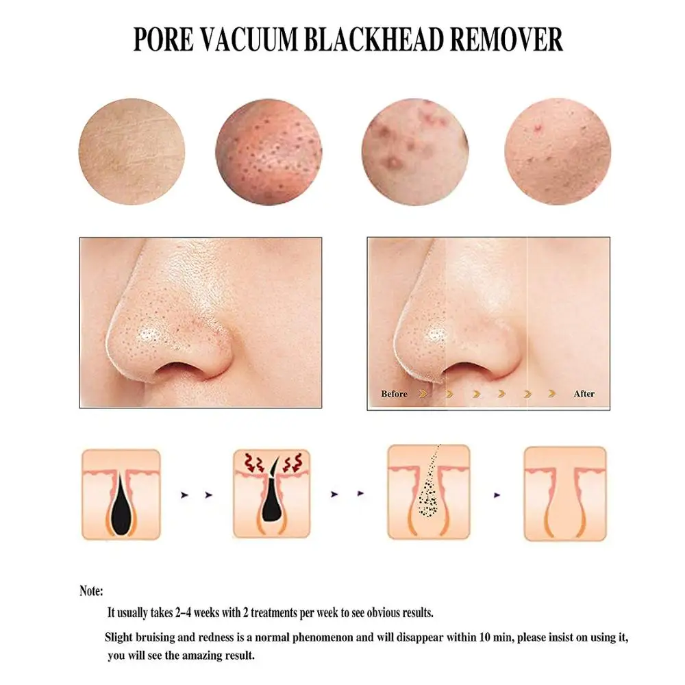 Электронное средство для удаления черных точек | Красота и здоровье