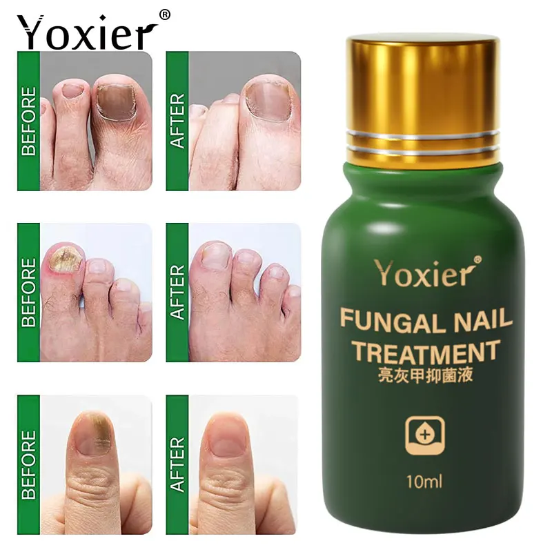 Сыворотка для лечения грибка ногтей эссенция восстановления паронихия