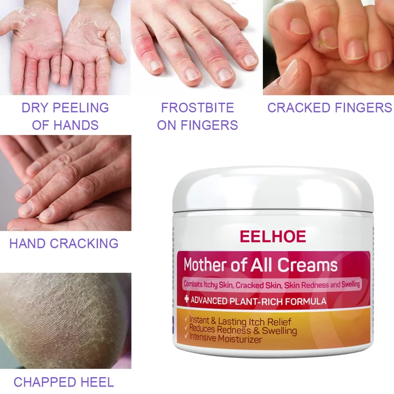 

EELHOE Psoriasis Cream Dermatitis Eczema Skin Ointment Treatment of Itching Body Massage Skin Care Anti-itch Moisturizing Cream