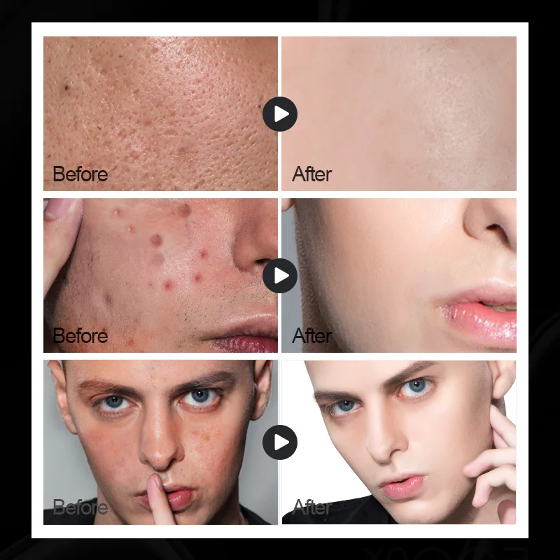 30 мл Мужская олигопептидная Очищающая Сыворотка для лечения акне мужской т