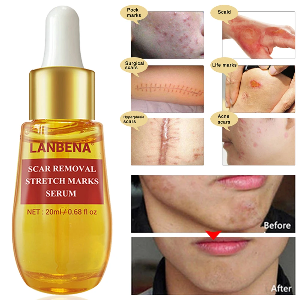 

Herbal Formula Scar Serum For Face Body Hyperplastic Scars Stretch Marks Removing Treatment Scar Serum Compound Essential Oil