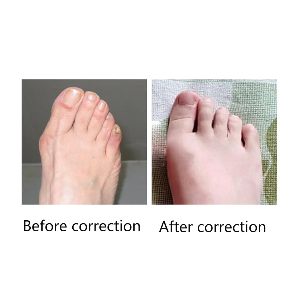 

1 Pair Corrector Silicone Stretch Spacers Soft Relax Hallux Valgus Straightener Spreader Toe Separator Bunion Relief Comfort