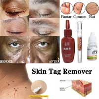 skin tag remover genital wart treatment removal mole papillomas foot corn medical repair tool natural bacteriostatic liquid