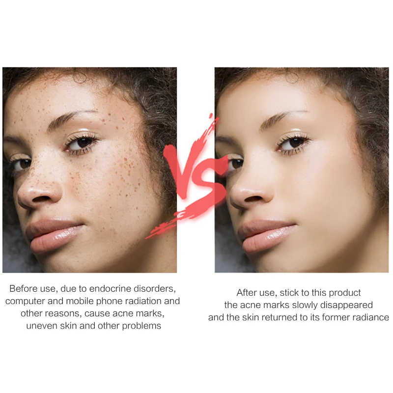 Оригинальный Sesderma Acne средство для уменьшения шрамов Сыворотка 15 мл ACNISES Spot color Cream