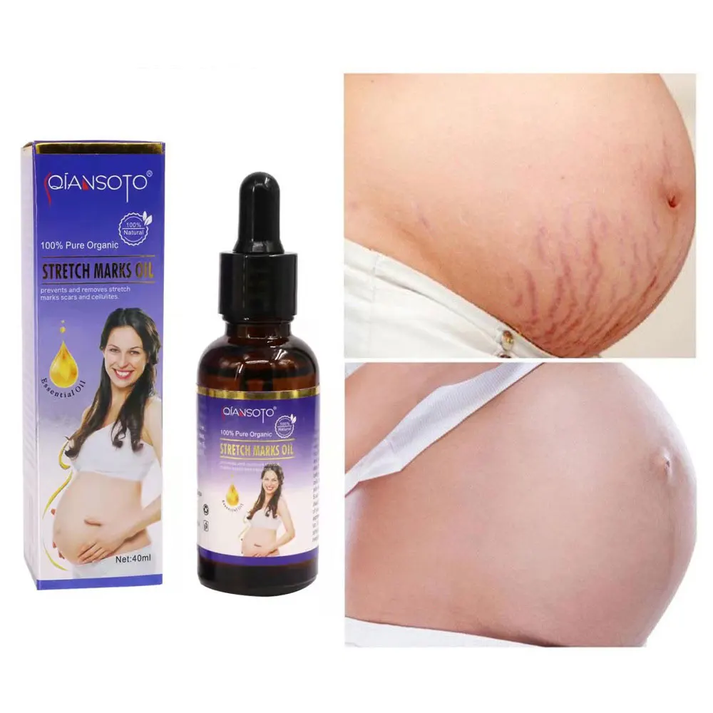 

Stretch Cream Organic Deep Scar Removing Treatment Repair Anti Pimples Marks Acne Stretch Marks Removal Cream Maternity Slack