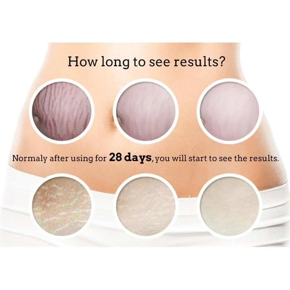 

Stretch Marks Remover Essential Cream Skin Care Treatment For Stretch Mark Removal Oils Cream Maternity For Pregnant Slackl I3U7
