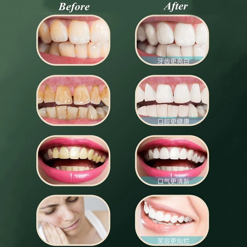 

Household Dental Calculus Remover Electric Tartar Remover Tartar Ultrasonic Whitening Usb Rechargeable Tooth Cleaner Portable