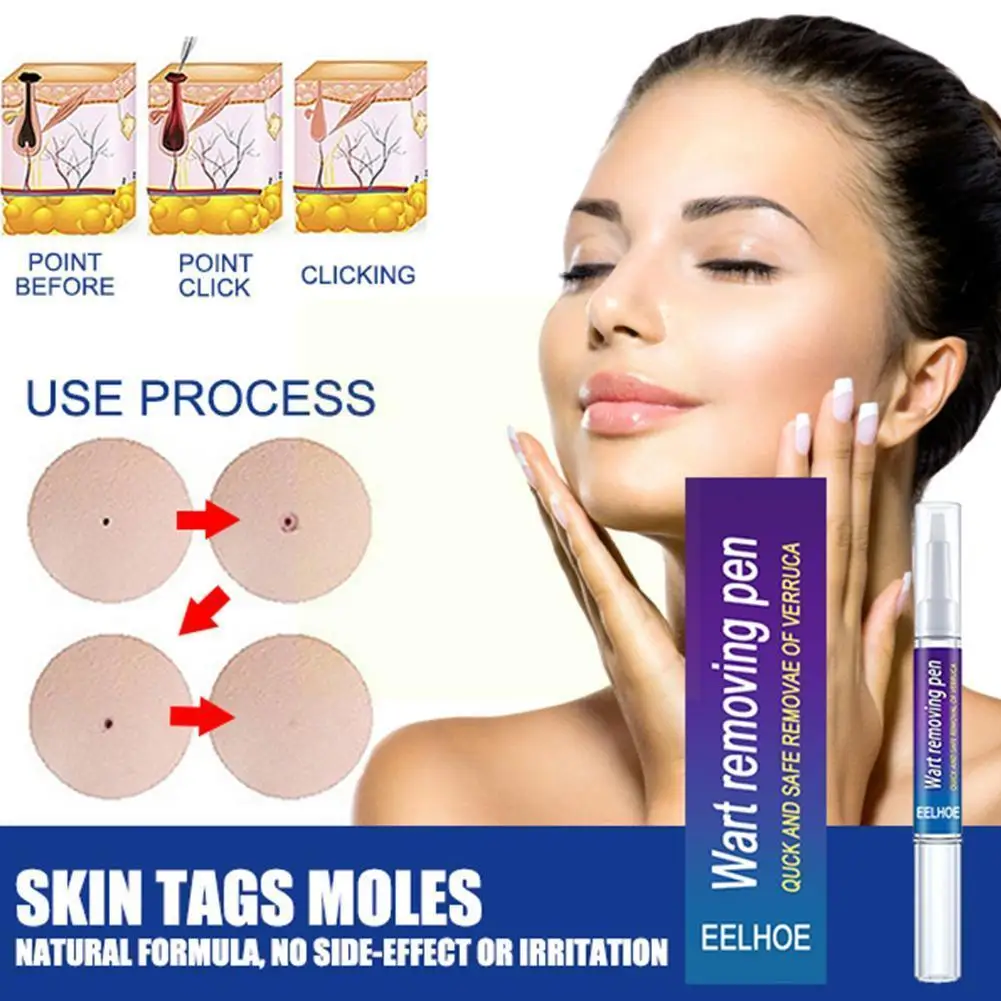 

Removal Genital Wart Treatment Papillomas Skin Tags Remover Effective Rapidly Anti Moles Verruca Removing Against Remedy J1l5