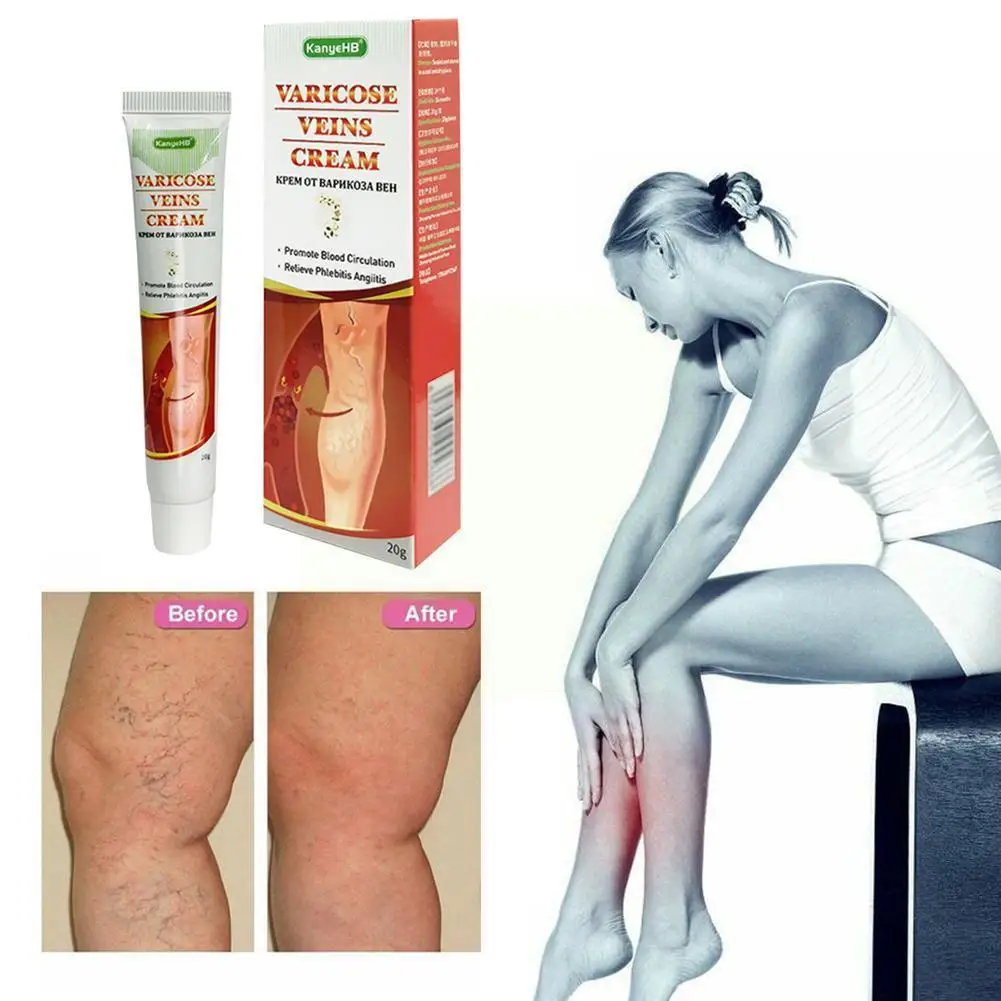 

20g Vasculitis Phlebitis Spider Cream Varicosity Angiitis Inflammation Varicose Veins Medical Removal Herbal Ointmnet Plast S5w1