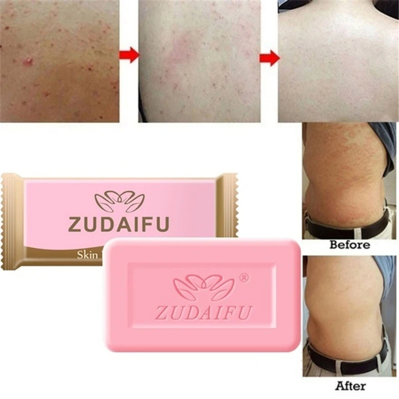 5pcs Brand Sulfur Soap Anti-mites Anti-acne Body Cleansing Soap Skin Treatment Acne Psoriasis Seborrhea Eczema Anti Fungus TTCC