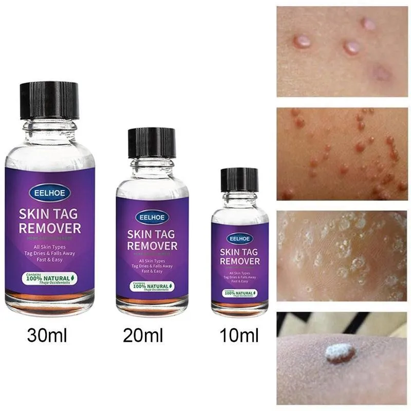 Антибактериальная жидкость для удаления бородавок 10/20/30 мл | Красота и здоровье