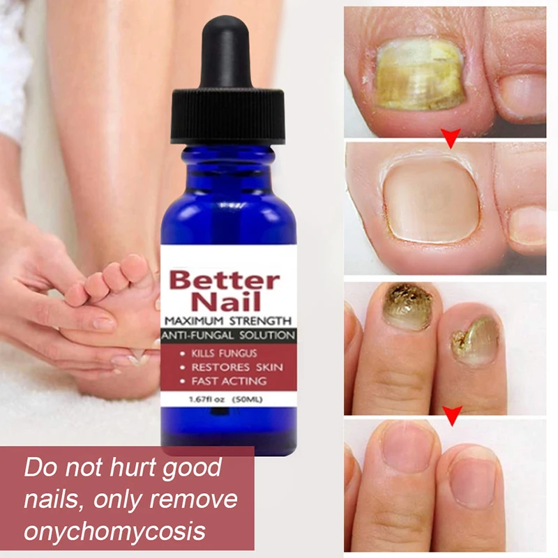 

50ml Nail Repair Liquid Anti Fungus Toe Serum Remove Nail Onychomycosis Essence Nail Treatment Liquid Hand Foot Care SSw