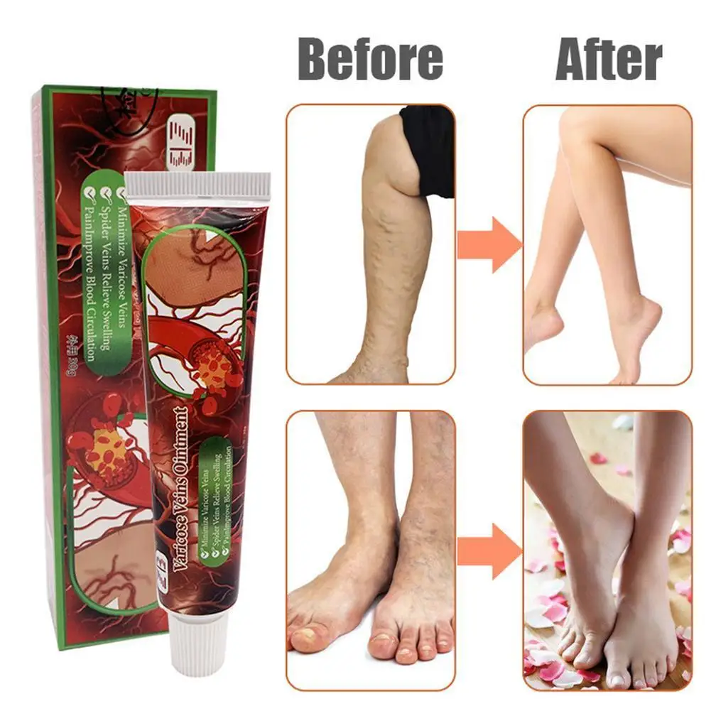 

20g Varicose Vein Treatment Cream Chinese Herbal Varicosity Angiitis Removal Phlebitis Spider Leg Veins Pain Plaster Body Care