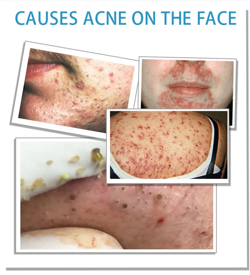 

1pc FAIR KING Acne Treatment Blackhead Removal Anti Acne Cream Oil Control Shrink Pores Acne Scar Remove Face Care Whitening