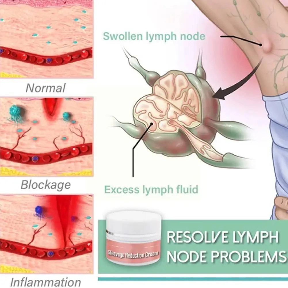 

The Secondary Cream Eliminates Underarm Milk To Relieve Underarm Lymph Node And Breast Inflammation Breast Swelling U0p1
