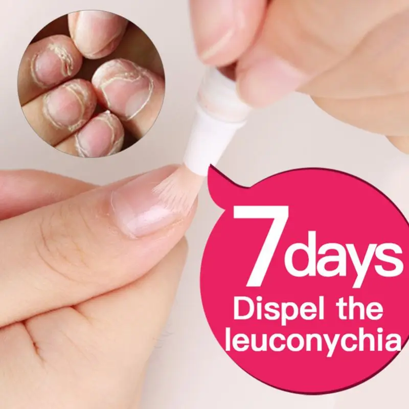 Натуральная травяная ручка для лечения грибка ног 3 мл питательный раствор уход