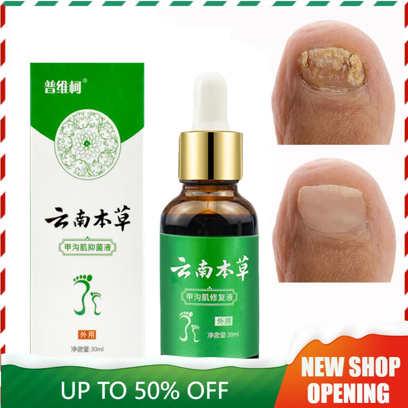 

Effective Nail Fungal Treatment Feet Care Essence Nail Foot Toe Nail Fungus Removal Gel Anti Infection Paronychia Onychomycosis
