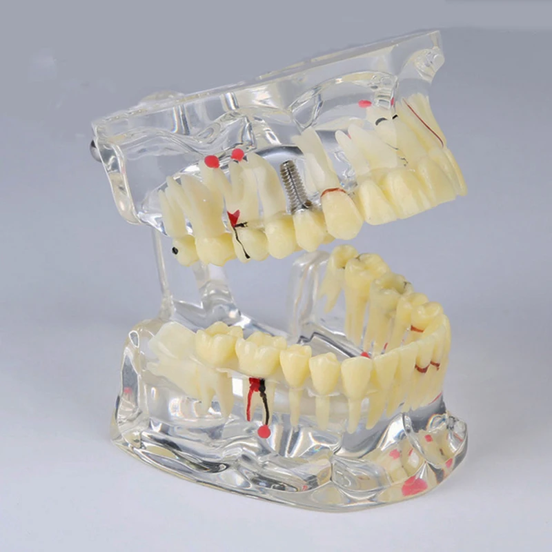 Стоматологическая прозрачная взрослая патологическая Модель дисплея зубов
