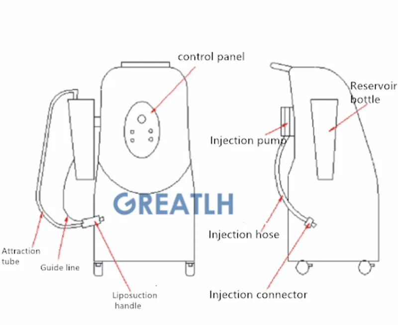 Рисунок 5 - Инфильтрация жира для удаления
