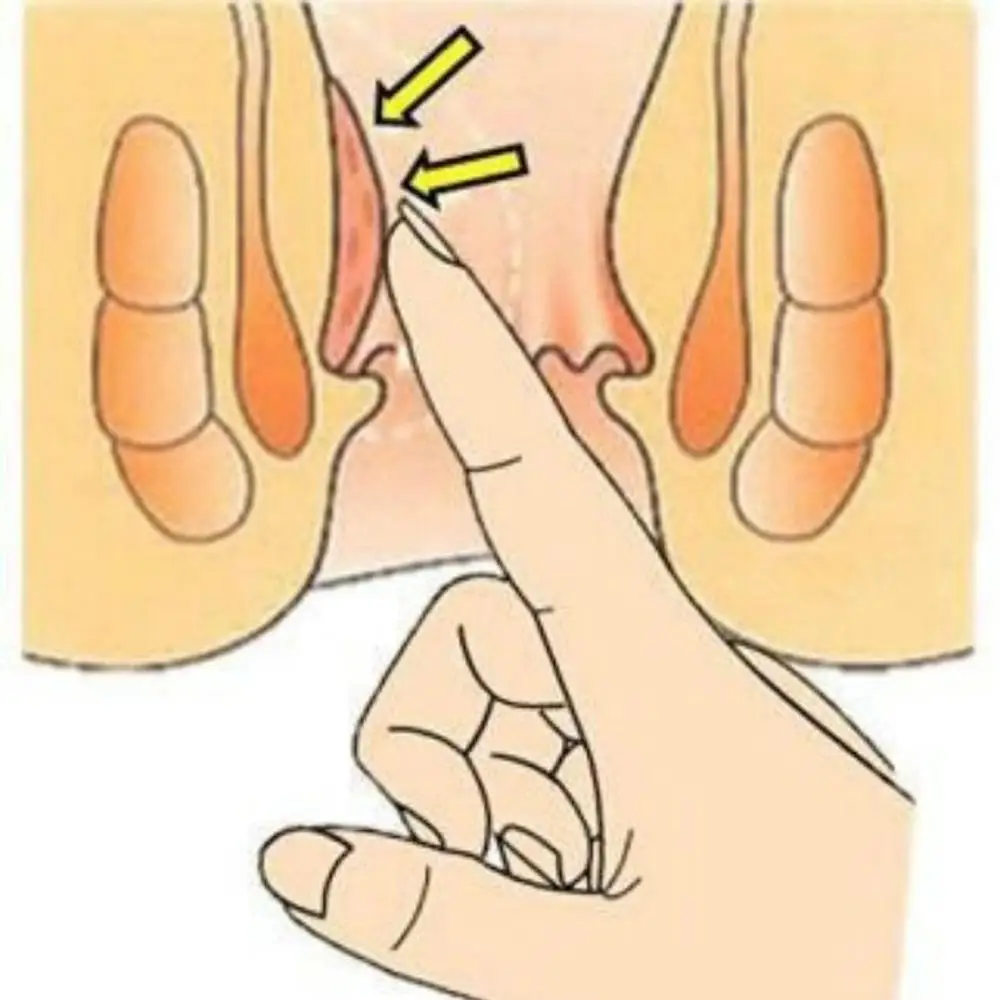 30 г китайские травяные экстракты крем от геморроя мазь внутренние наружные