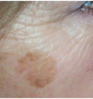 korean 100 ml sun spot age spot brown spot dark spot removertreatment corrector no scam
