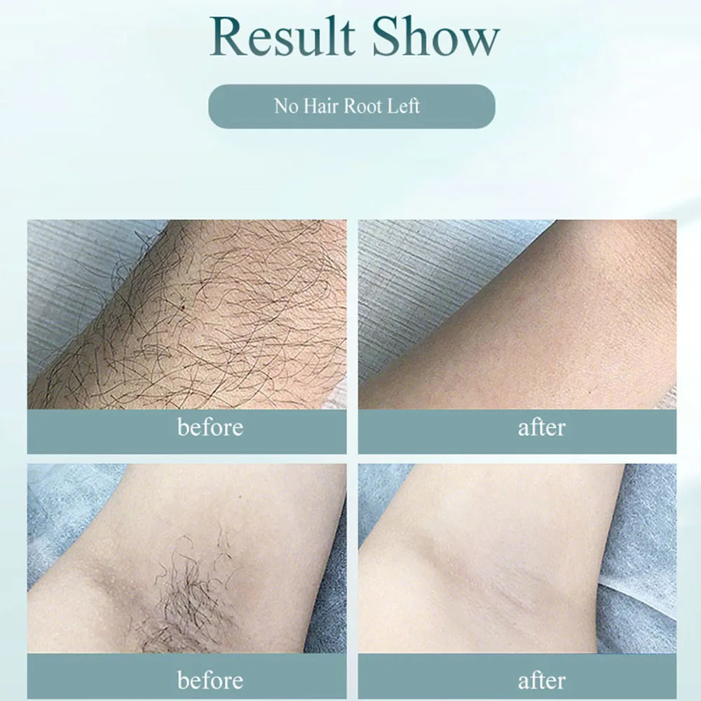 2020 New Laser Epilator Permanent IPL Photoepilator Hair Removal depiladora Painless electric Dropship 900 000 Flashes | Бытовая
