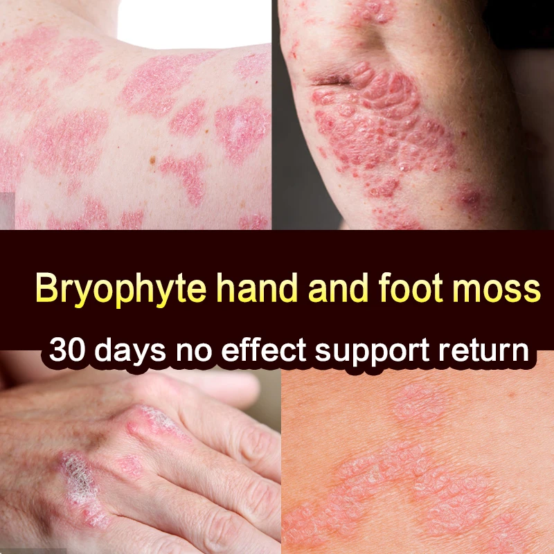 Крем для лечения псориаза дерматита экземы 30 г | Красота и здоровье