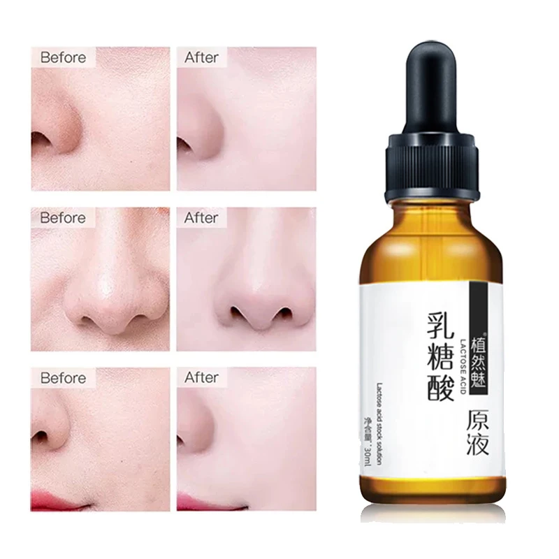 Т-зона лактозы кислота уменьшает поры Сыворотки увлажняющий разблокировать пор