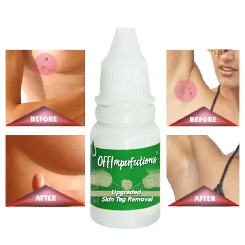 

10ml Skin Tag Removal Foot Corn Removal Plantar Genital Treatment Liquid Warts Remover Skin Tag Warts Body Ointment Y5G7