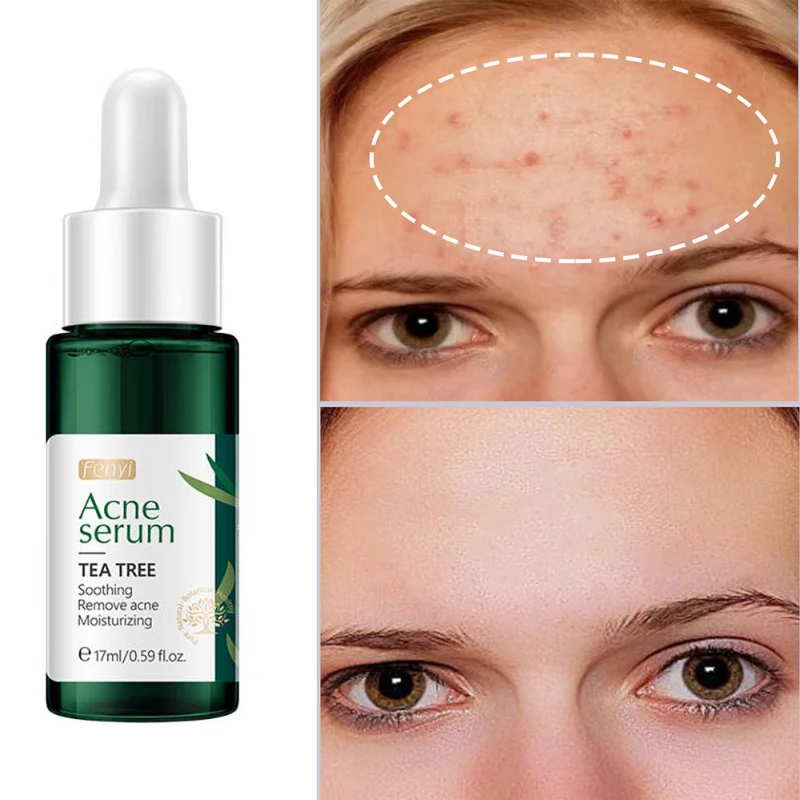 

Tea Tree Effective Acne Removal Serum Anti-acne Blackhead Remover Repair Gel Oil Control Whitening Moisturizing Face Skin Care