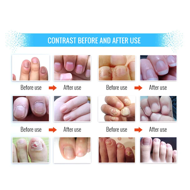 

Newly Nail Repair Care Liquid for Toenail and Fingernail Hydrates Repair Yellow Cracked Nails CLA88