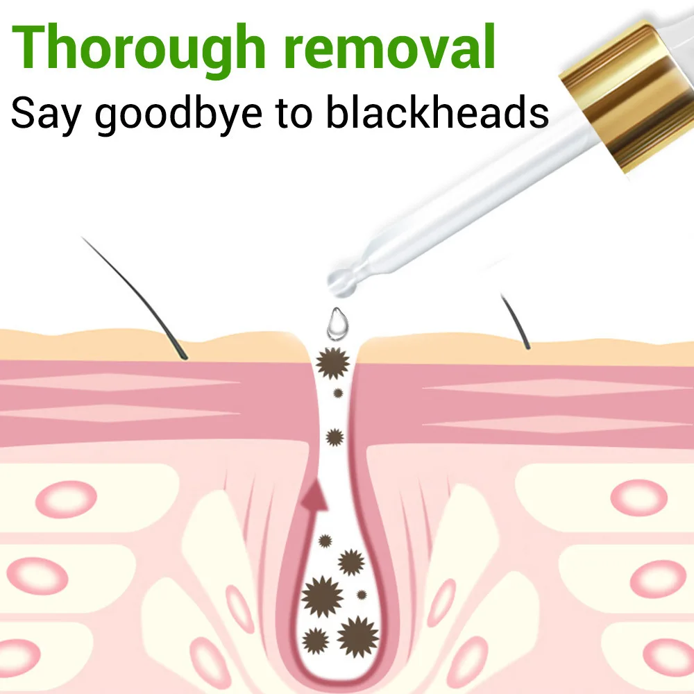 Горячая продажа 15 мл масло контроль удаления черных точек отшелушивает