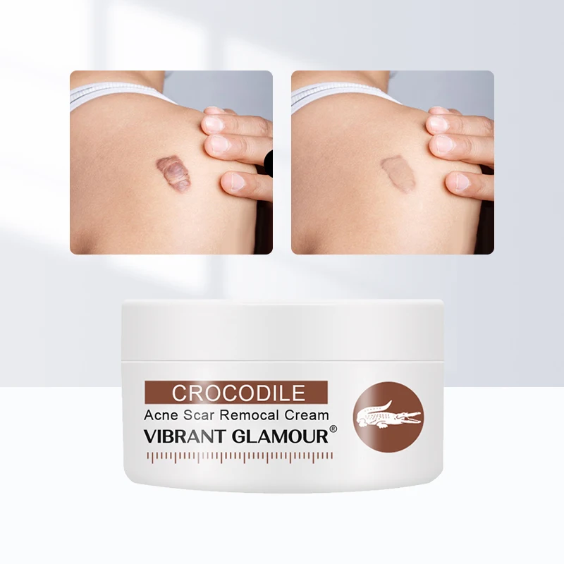 

Acne Scar Removal Cream Gel Face Pimples Stretch Marks Cream Repairing Smoothing Whitening Moisturizing Body Cream Skin Care 30g