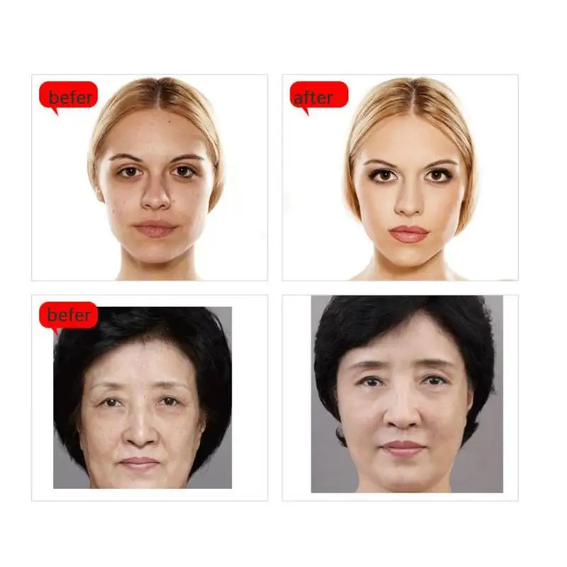 Гиалуроновая кислота заправка газовый баллон для мезотерапии замороженная Кожа