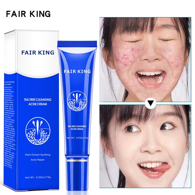 

Deep Cleansing Acne Cream To Repair Blackheads Shrink Pores Remove Scars Oil Control Whitening Facial Skin Care Products