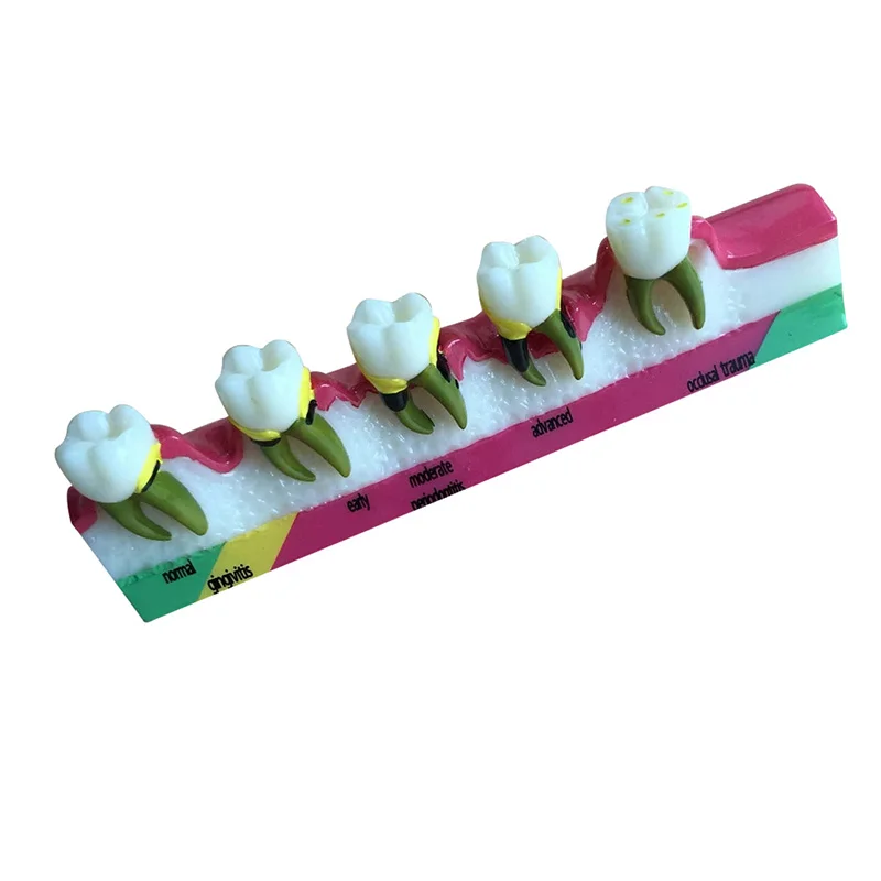 Стоматологическая модель зубов Пародонтоз ассортная классификации зубов|dental