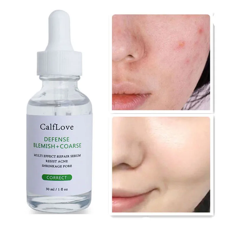 

Salicylic Acid Solution Face Serum Acne Treatment Face Essence Shrink Pores Serum Oil Control Close Mouth Smooth Skin Care 30ml