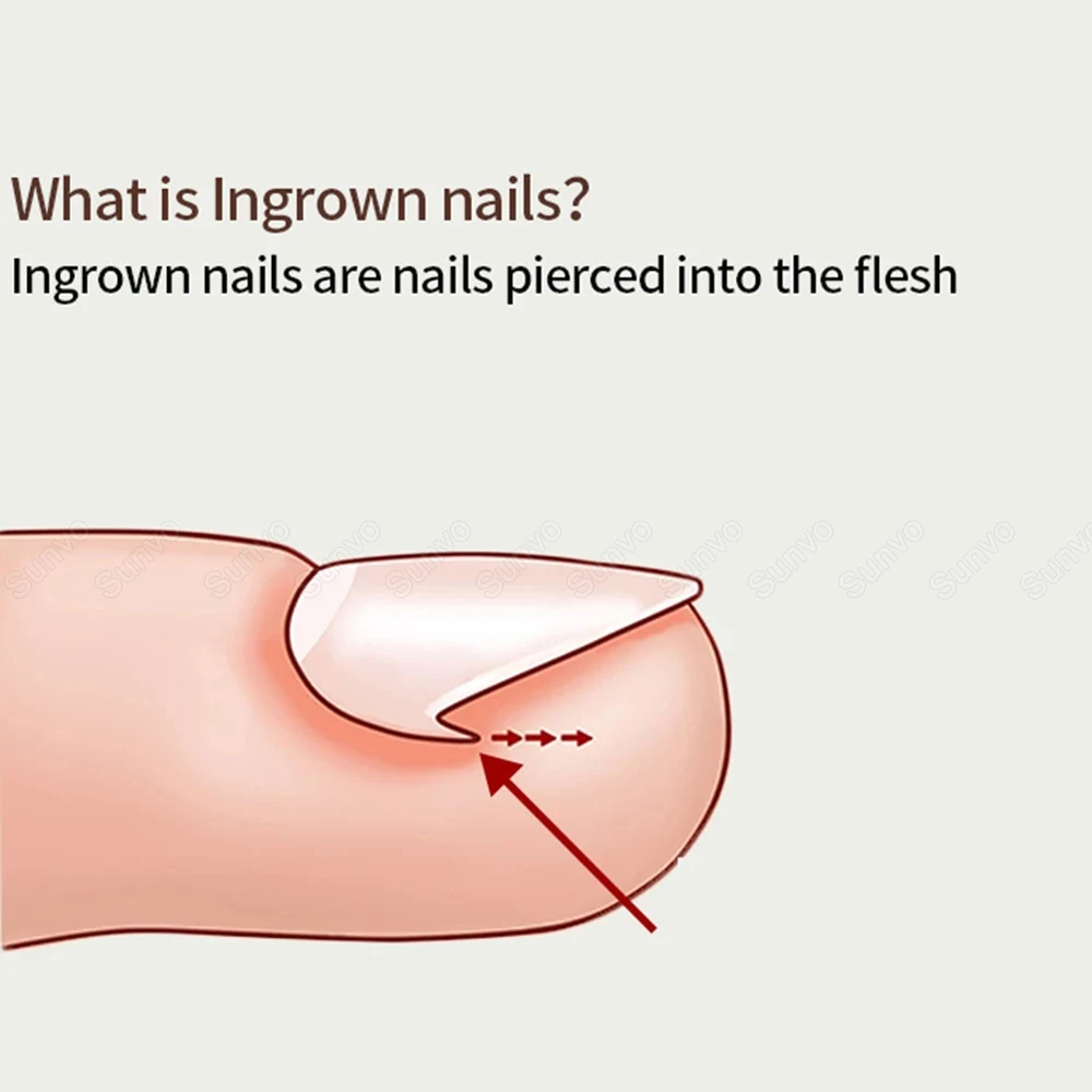 10 шт./компл. корректор для вросших ногтей наполнитель наклейка выпрямления